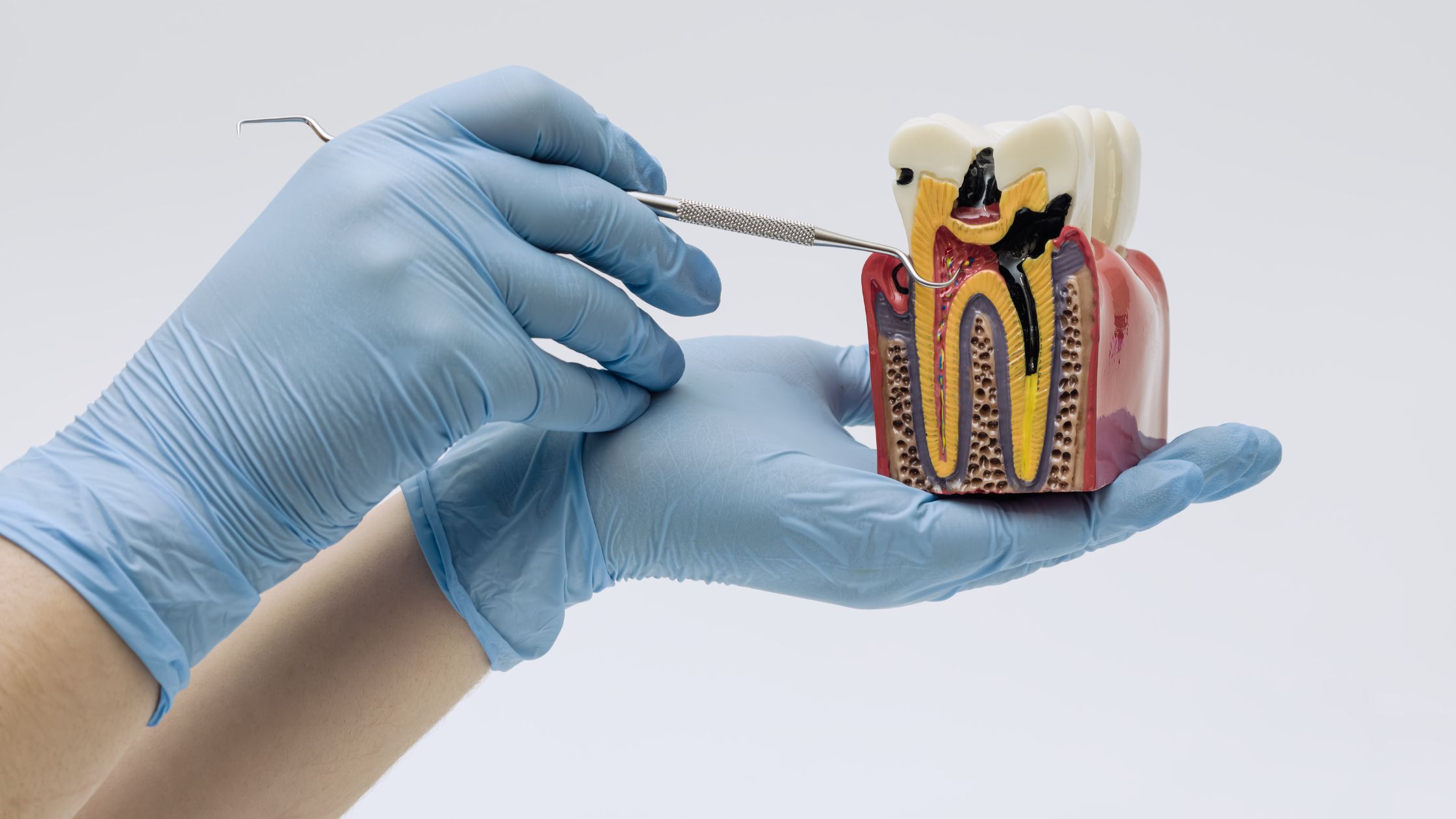 Pourquoi certaines personnes ont plus de caries que d’autres